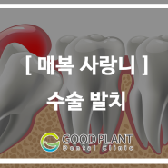 매복 사랑니 수술 발치, 굿플란트치과