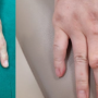 손가락관절부음 마디 뻣뻣함 지속 땐 류마티스 관절염 의심