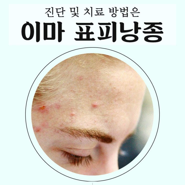 이마 표피낭종 진단 및 치료 방법은 : 네이버 블로그