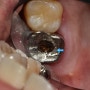 씌운 치아 안쪽이 썩은 경우 치료방법에 대해 살펴봅시다.