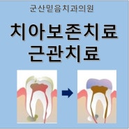 군산 미장동 치과 - 치아 보존치료(근관치료)