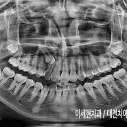 대전치아교정전문 이세현치과 ] 송곳니매복 교정