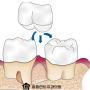 어금니 음식물 낌 증상 원인과 치료법