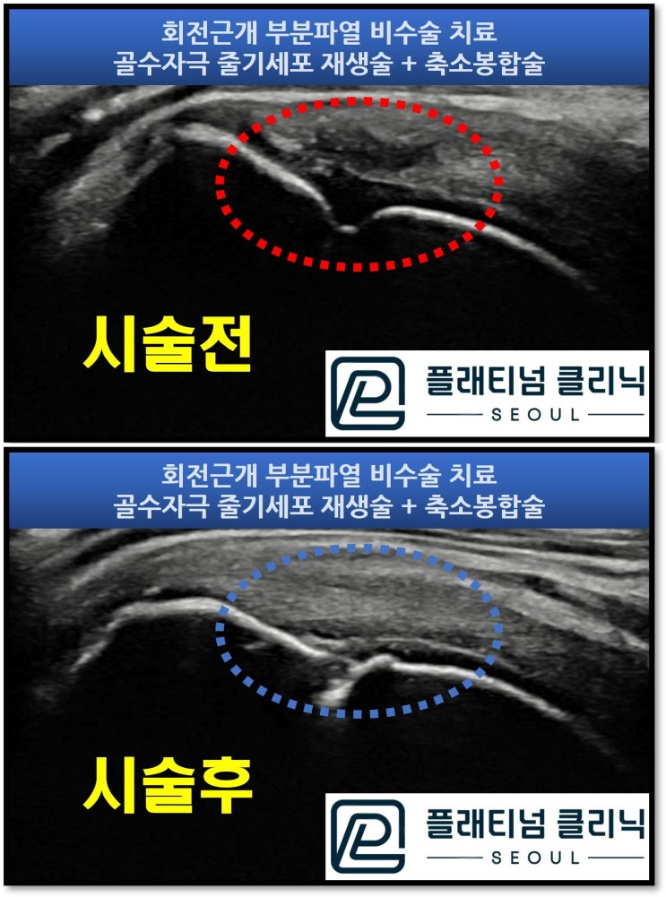 (강남어깨병원, 플래티넘의원) 회전근개파열. 더이상 방치하지 말고 제대로 치료합시다.