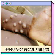 원숭이두창 증상 격리 원인 치료방법