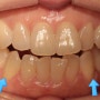 교합평면의 중요성과 치아 중심선, 얼굴안면비대칭에 관한 이야기