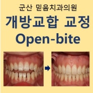 군산 미장동 치과 개방교합(open-bite) 교정치료