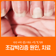 손톱 조갑박리증 원인, 치료 무슨 병원에 가야하나요?