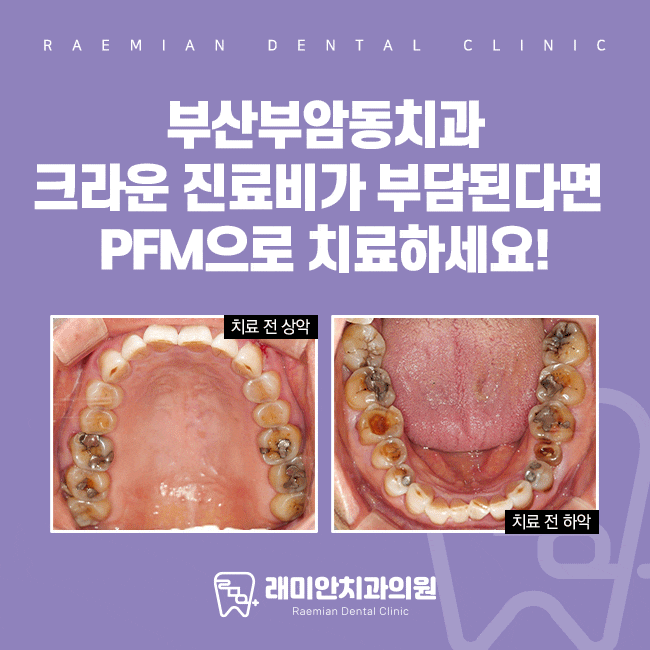 부산부암동치과 크라운 진료비가 부담된다면 PFM으로 치료! : 네이버 블로그