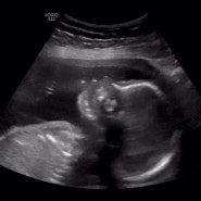 또로 임신일기 💕 19주 - 22주 임산부 기록 ( 중기 정밀초음파, 배크기 )