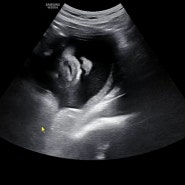 [임신 34주] 손가락 통증ㅜ 막달검사