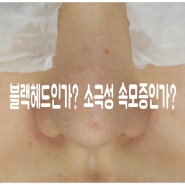 블랙헤드인가? 소극성 속모증인가?