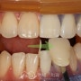 문래역 치과 잘하는곳 에서 누런 치아 미백치료 과정