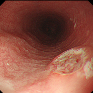 [목 이물감/통증] ② 식도 궤양(Esophageal ulcer)