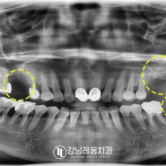 치과공포증 & 헛구역질 (구역반사)이 심한 50대 여성환자 수면마취 후 임플란트 4개 식립 사례