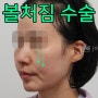 볼처짐수술 필요하다면 안면거상잘하는곳 찾아야