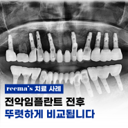 전악임플란트 전후 치료 경과는 뚜렷합니다