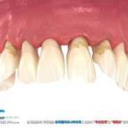 아래앞니 임플란트 후기 앞니흔들림 형태