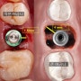 큰 어금니의 발치 즉시 임플란트 ; 장점과 단점