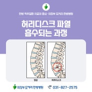 의정부한방병원 허리디스크 파열, 흡수되는 과정