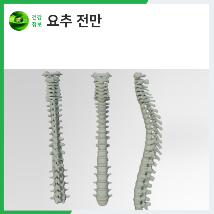 요추 전만 자세 흉추 후만 때문에 척추가 틀어졌다면 : 네이버 블로그