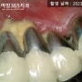마산역 치과 - 위 아래 앞니 어금니 전체 임플란트 수술, 체계적인 방법으로 받는 것이 좋습니다.
