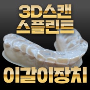 강남 이갈이, 턱관절 치료 장치 스플린트 이제 3D구강스캐너로 편리하게