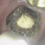 동탄역 치과 , 부러진 치아 임플란트를 하지 않고 치료할 수 있다?