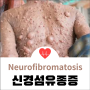 신경섬유종증 정의, Neurofibromatosis 유전 진단과 제1(NF1)과 2(NF2)형 색소침착 반점과 종양 증상 및 수술과 방사선 치료