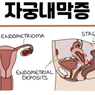 자궁내막증 증상 초기 수치별 난소혹 진단