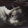 임신 일기 - 4주~8주 ( 23.6.3 ~ 6.30 )