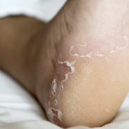 발 뒤꿈치 가려움 원인 및 증상 10가지 단순한 피부병 외에도 발생할 수 있는 상황