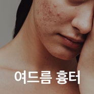 송도여드름흉터 치료과정, 붉은패인자국이 고민이라면 -[송도오라클피부과]