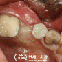 단단한 잇몸에 제대로 된 임플란트 심어주는 영등포역 치과