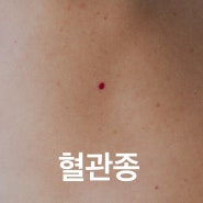 송도피부과 혈관종, 손가락에 생긴 빨간점? -[송도오라클피부과]