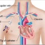 마취과 / Dialysekatheter, Shaldonkatheter