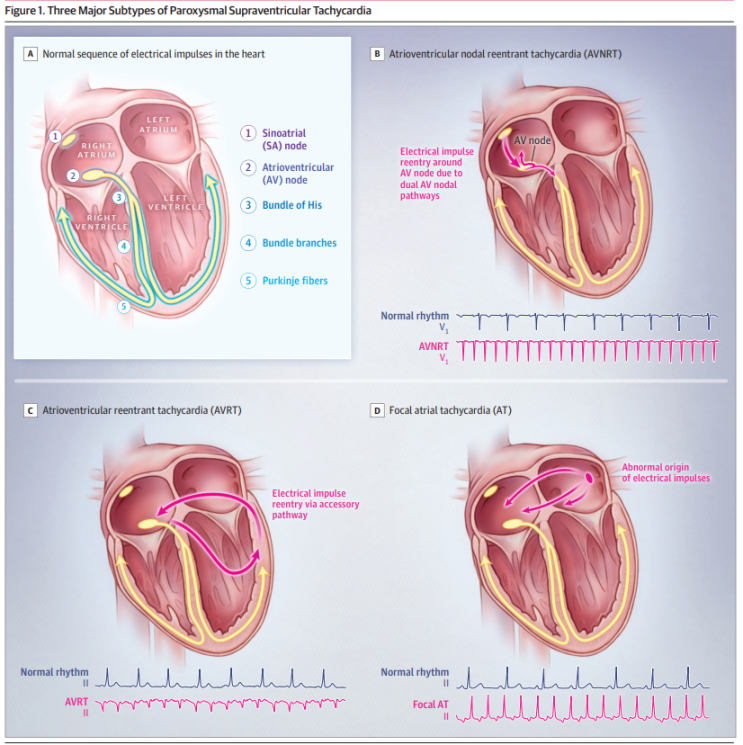 발작성 상심실성 빈맥의 처치 (Management of Paroxysmal Supraventricular Tachycardia ...
