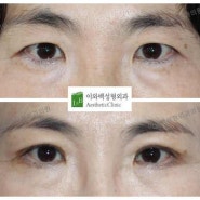 눈꺼풀 쳐짐이 있는 50대 여성에서 상안검수술(5주차부기)