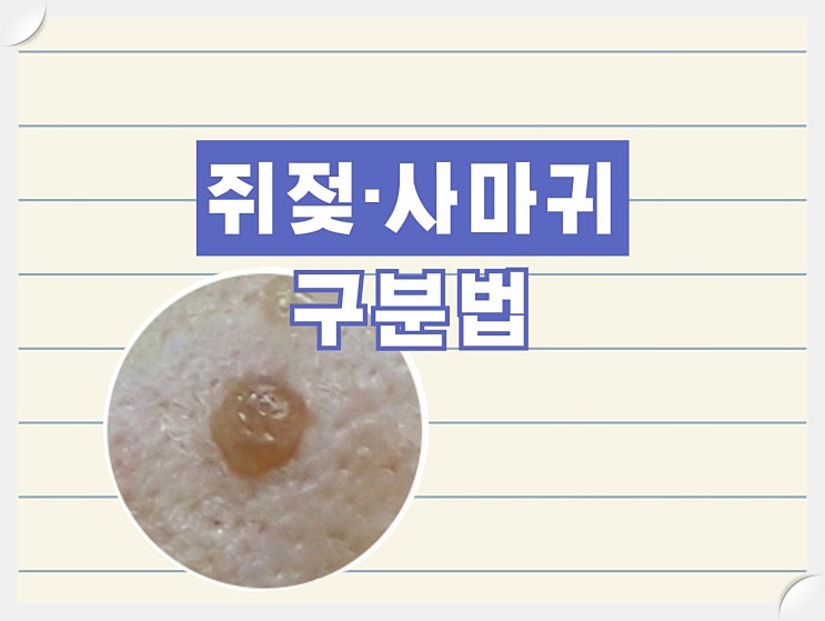 목쥐젖제거시 주의사항, 쥐젖/ 사마귀 구분법 : 네이버 블로그