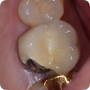 씌운 치아(크라운/금니)에 충치가 다시 생겼을 때 치아를 살릴 수 있나요?