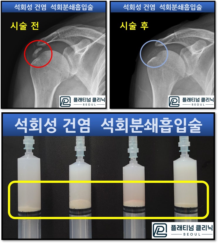 (강남어깨병원, 플래티넘의원) 외국에서도 석회분쇄흡입술을 받으러 오시는 병원.