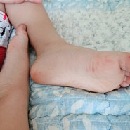 아기 수족구 초기 증상 손 발 수포 유아 구내염 전염 격리 기간 등원