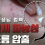 '붉은끼 화농성 여드름' 압출 미리 보기 -참진TV, 압출킹