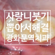 위턱 사랑니 붓기 뽑아서 해결 광화문역 치과