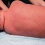 아기 열꽃 증상과 보습의 중요성