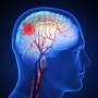 미니 뇌졸중, 지나치지 말아야 할 주요 증상 및 예방법