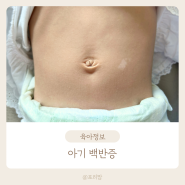 아기 백반증 원인 증상 진단 검사 치료