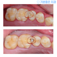 종로 5가 치과, 어금니 충치치료 세라믹 인레이로 치료한 사례