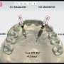 [부산전체임플란트] 디지털 풀아치로 전체 치아를 회복하세요