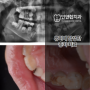 [아동 치과 주치의] 유치에 발생한 충치 치료